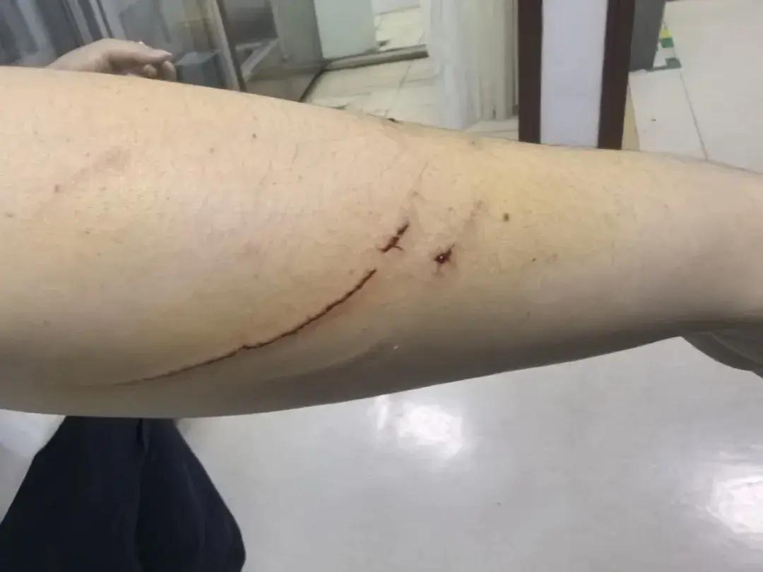 半个月近200例,宁波近期高发!一旦发病,死亡率几乎100%